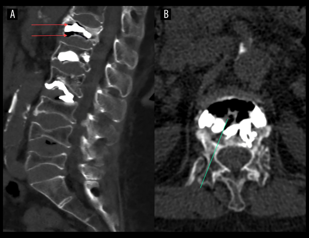 Computed tomography (CT) scan from a 71-year-old woman with bone cement dislodgement (BCD) following percutaneous kyphoplasty (PKP) of a T12 vertebral fracture before treatment with repeat vertebroplasty. (A) The scan shows a cavity around the cement, as indicated by the red arrows. (B) The CT scan shows a passage to the cavity, indicated by a green line.