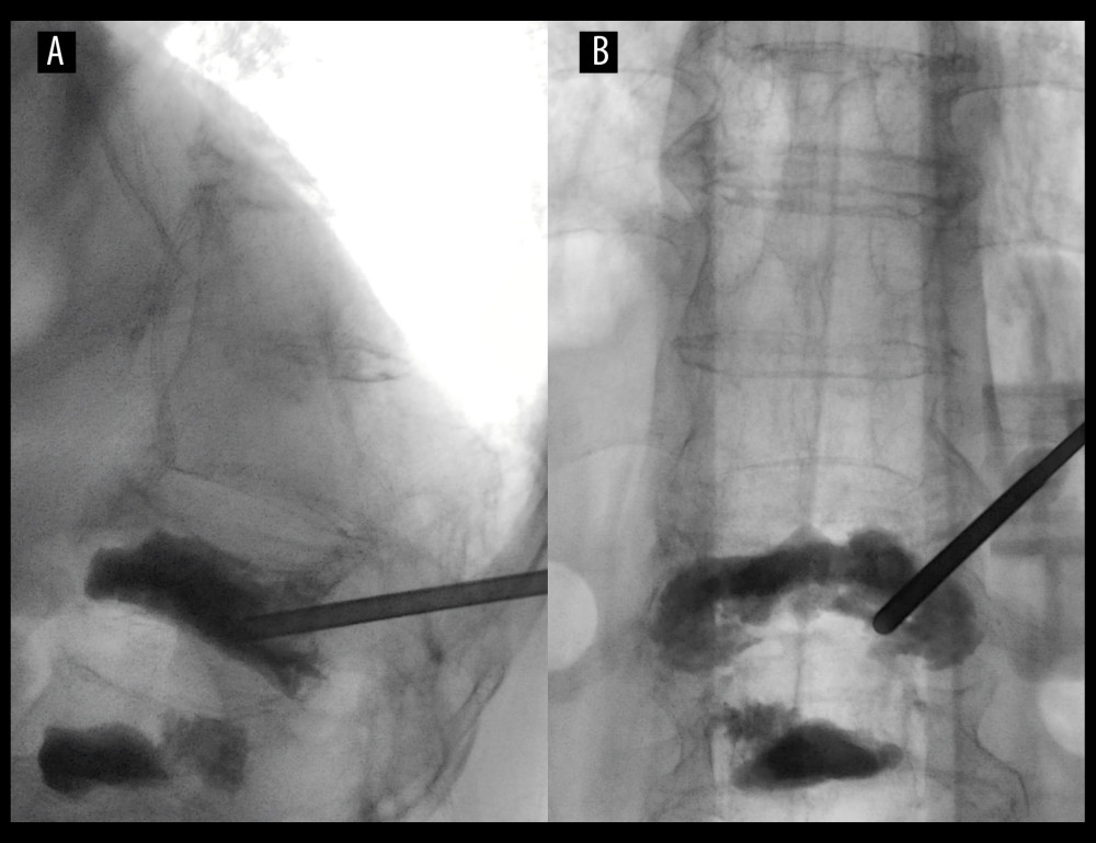 Intraoperative X-ray. (A) The X-ray shows the cannula was placed to the posterior two-thirds of the inferior endplate along the right pedicle. (B) The cannula was placed to the area not filled by the original bone cement.