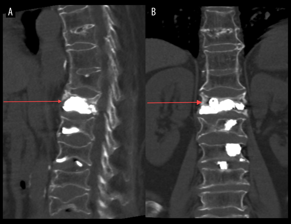 CT scan after the repeat VP. (A, B) Show the cavity was filled by cement, marked with red arrows.