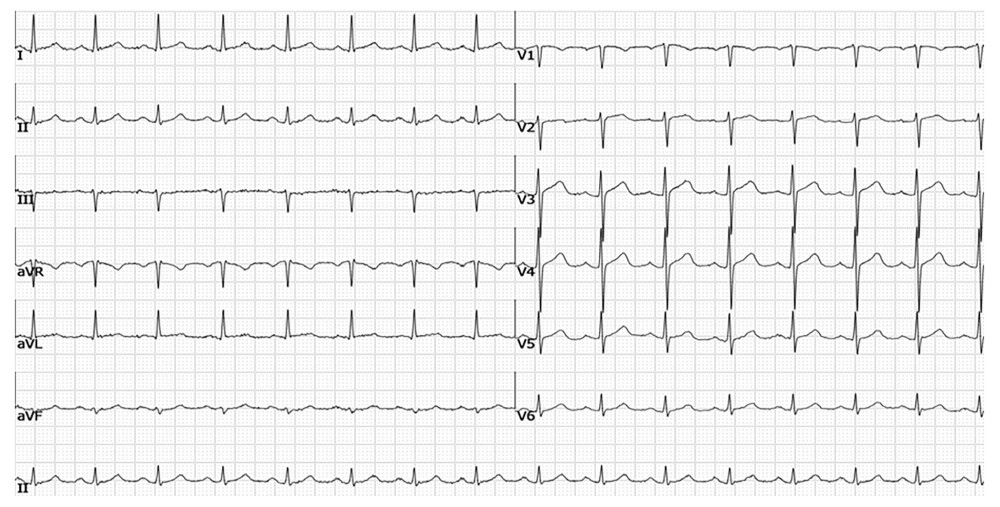 Electrocardiogram is suggestive of sinus rhythm.