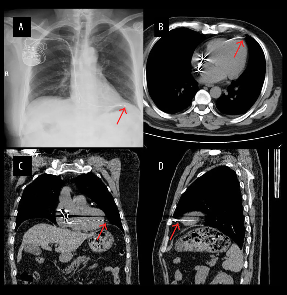 (A) Chest X-ray showed the right ventricular lead over the left edge of the heart. (B–D) Chest computed tomography showed the pacing lead crossing the left ventricle and pericardium.