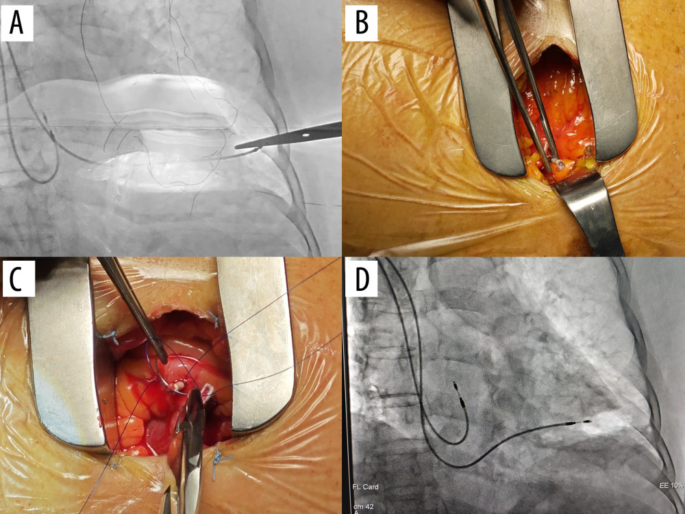 (A) Fluoroscopic positioning of the pacing lead at the point of penetration into the ventricle. (B) The pacing lead was advanced through the pericardium and into the thorax under. (C) A suture was passed through the tip of the lead. (D) Fluoroscopic image of the lead positioned within the left ventricle.