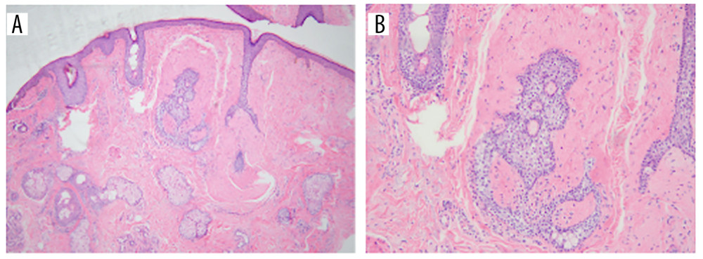 Skin lesions on the face of a 57-year-old Chinese woman were pathologically diagnosed as fibrofolliculomasThe epidermis is normal, and hyperplasia of fibrous connective tissue is visible in the dermis (A, B). (H&E staining, magnification ×40 in A, magnification ×100 in B).