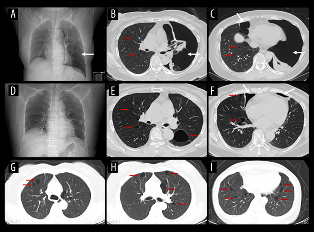 Chest imaging findings demonstrated the presence of multiple lung cysts with or without pulmonary pneumothoraxChest X-ray showed pneumothorax on the left side of the lung (A) and chest HRCT showed sparsely-distributed, thin-walled lung cysts in the lower lobes, with a large amount of pneumothorax at the left hemithorax and mild pneumothorax at the right hemithorax (B, C) of a 57-year-old Chinese woman, and subsequential chest X-ray (D) and chest HRCT performed after treatment of the pneumothorax (E, F). Chest HRCT demonstrated lung cysts in the subpleural (G, H) and basilar medial regions (I) of a 58-year-old Chinese woman. (White arrows indicate pulmonary pneumothorax, and red arrows indicate cystic lesions of the lungs).