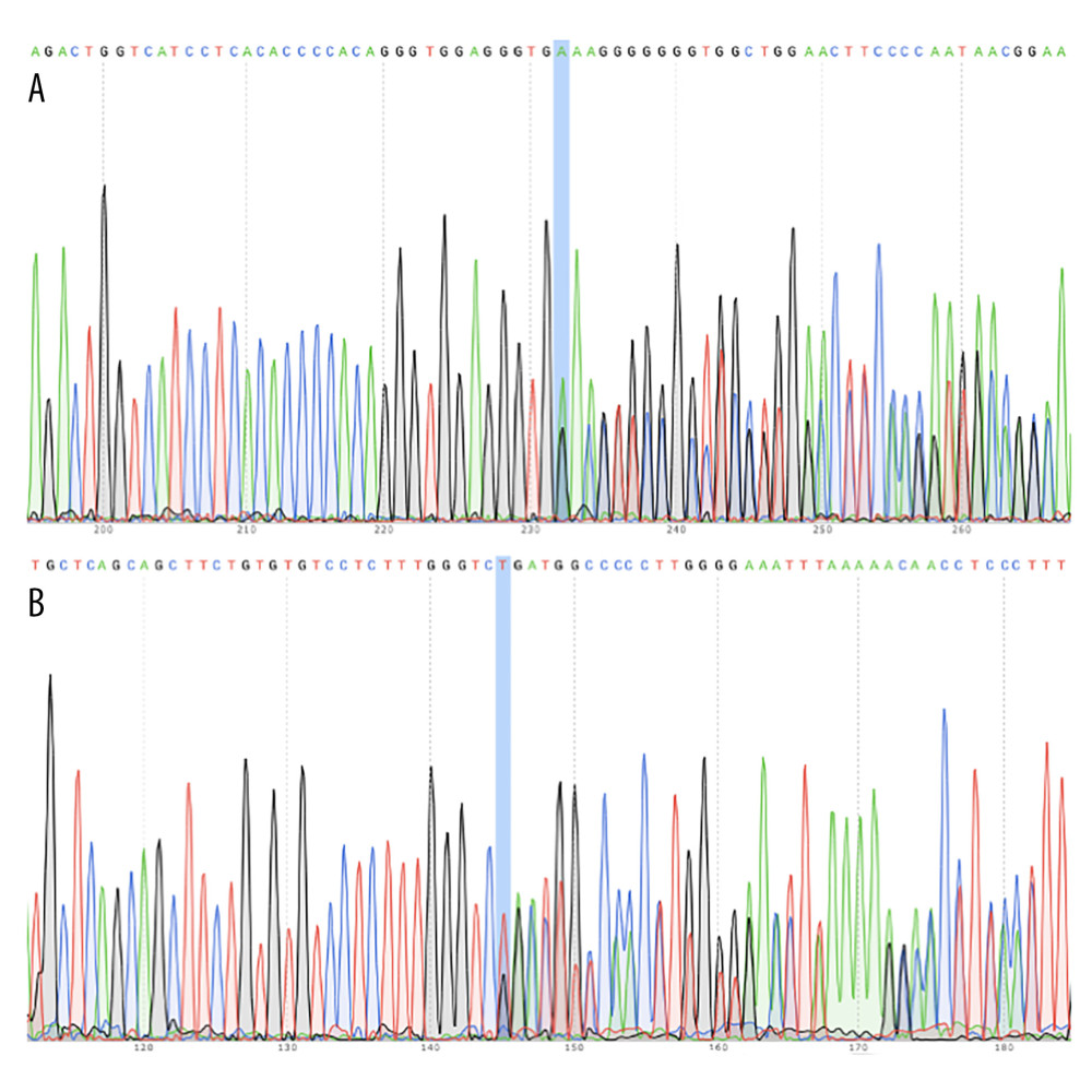 WES analysis identified mutation in FLCN geneWES revealed a novel mutation of FLCN gene in exon 12 of a 57-year-old Chinese woman (A). WES identified a mutation of FLCN gene in exon 14 of a 58-year-old Chinese woman (B).