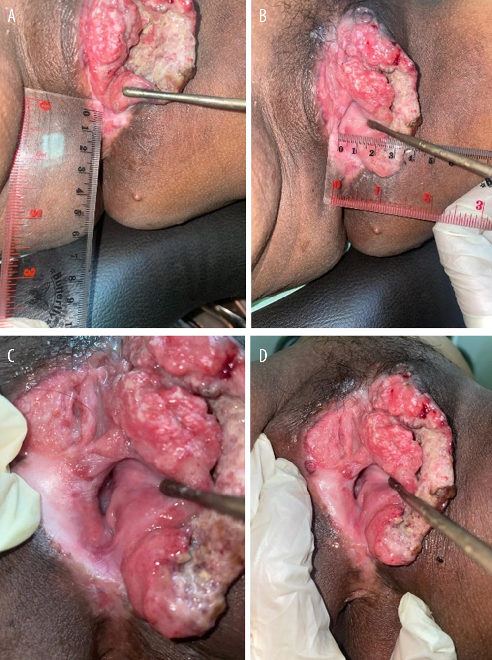 Vulvar mass at 30 weeks of pregnancy, (A) No infiltration to anorectal tissue; (B) 3 cm margin from vagina; (C, D) exophytic mass at left labia with clitoris involvement.
