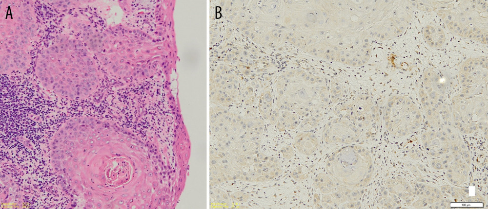 Histopathology and p16 immunohistology examination, (A) 100× enlargement shows keratin pearl formations alongside hyperplastic, hyperchromatic, and mitotic cell on vulval mass. (B) p16 Staining shows negative results.