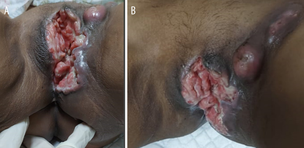Vulvar mass at 3 months postpartum. (A) Mass infiltrated to vagina, 1/3 upper urethra, and anorectal tissue. (B) Inguinal enlargement and ulcerated node.