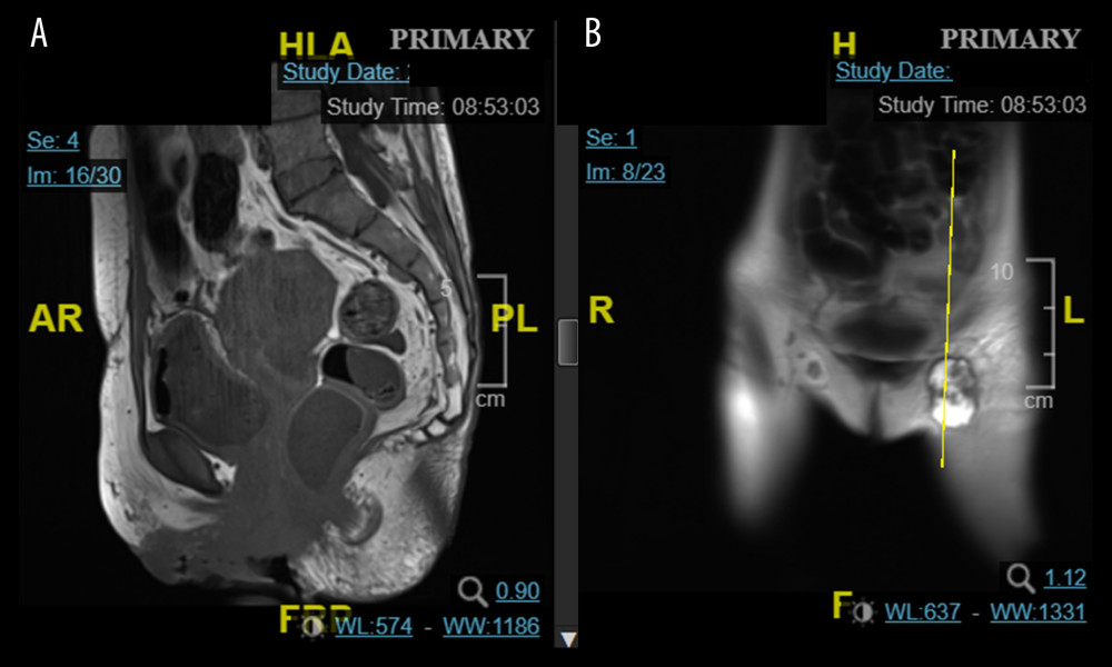 Pelvic MRI at 3 months postpartum. (A) Tumor shows infiltration of stroma; pubic part; and labia. (B) Metastatic nodule in left inguinal node.