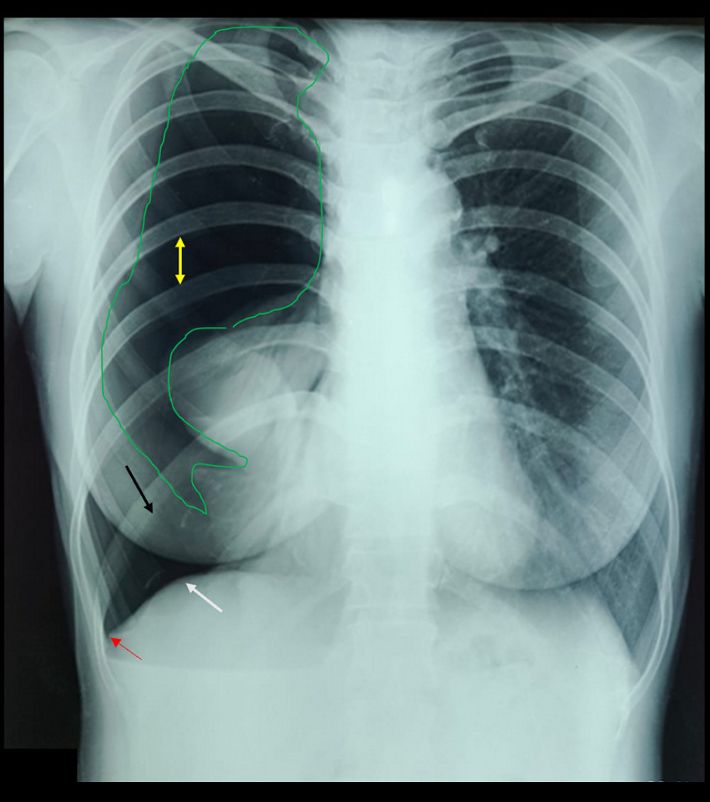 Chest X-ray on first hospital admission. Yellow arrow indicates increased rib separation; red arrow shows the deep sulcus sign; black arrow highlights air in the right hemithorax displacing both the diaphragmatic dome and the anterior costophrenic angle, indicating a large right-sided pneumothorax; the green arrow demonstrates lucency outlining the lung margin.