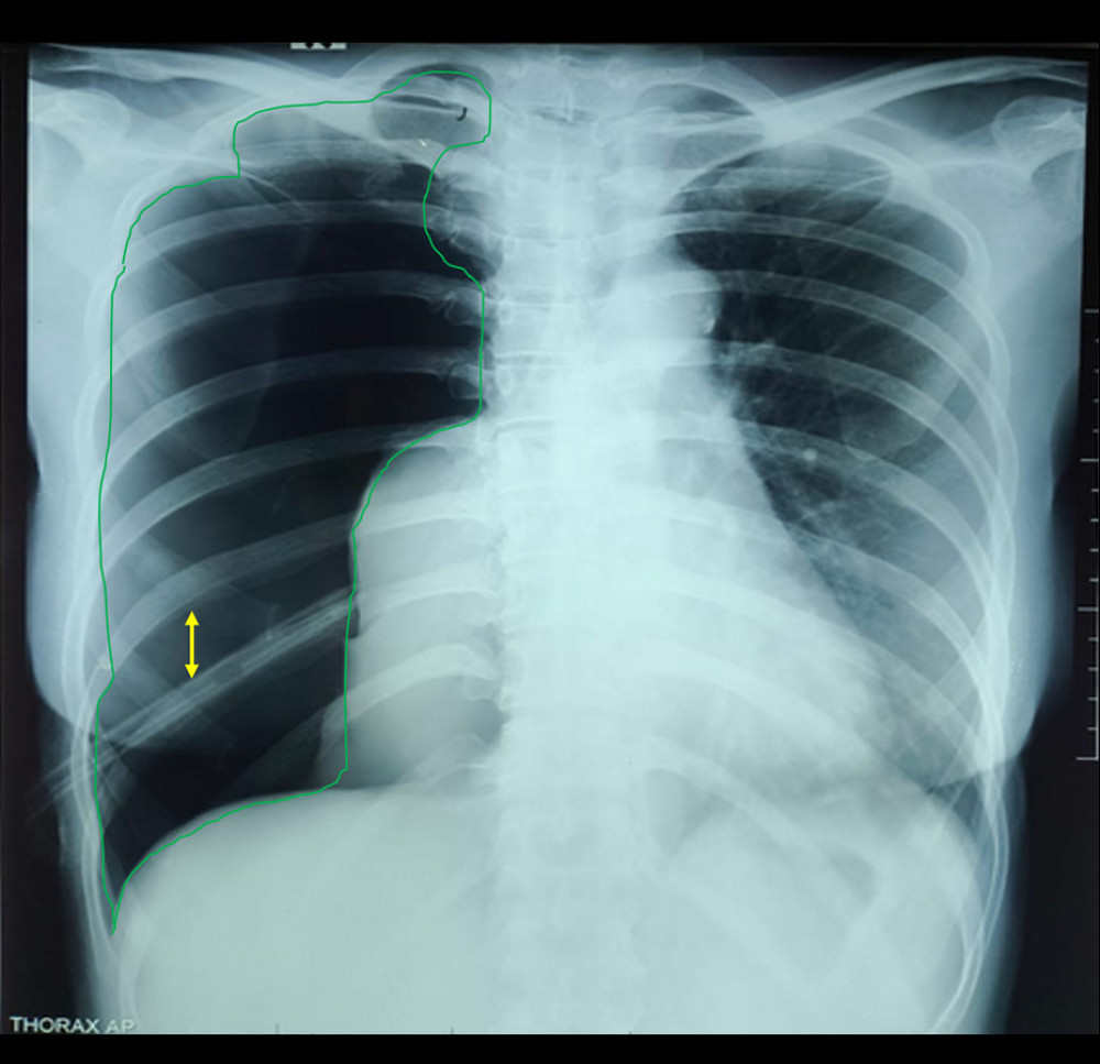 Follow-up chest X-ray from Soesilo Slawi Tegal Hospital shows a massive right pneumothorax. Yellow arrow indicates increased rib separation; green arrow highlights lucency along the lung margin.