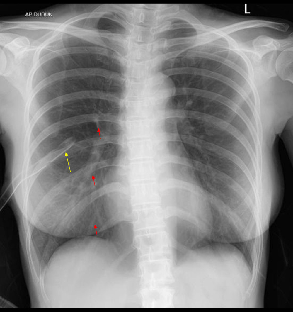 Follow-up chest X-ray shows minimal pneumothorax with water seal drainage in place. Yellow arrow indicates the drainage tube; red arrow shows reappearance of bronchovascular markings in the previously avascular pulmonary region.