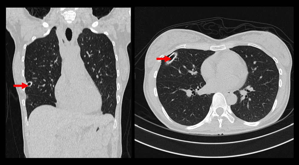 MSCT Thorax CT scan with contrast showing minimal right pneumothorax (on chest tube), and no masses/consolidations were seen in the bilateral lung. Red arrow shows a minimal pneumothorax.