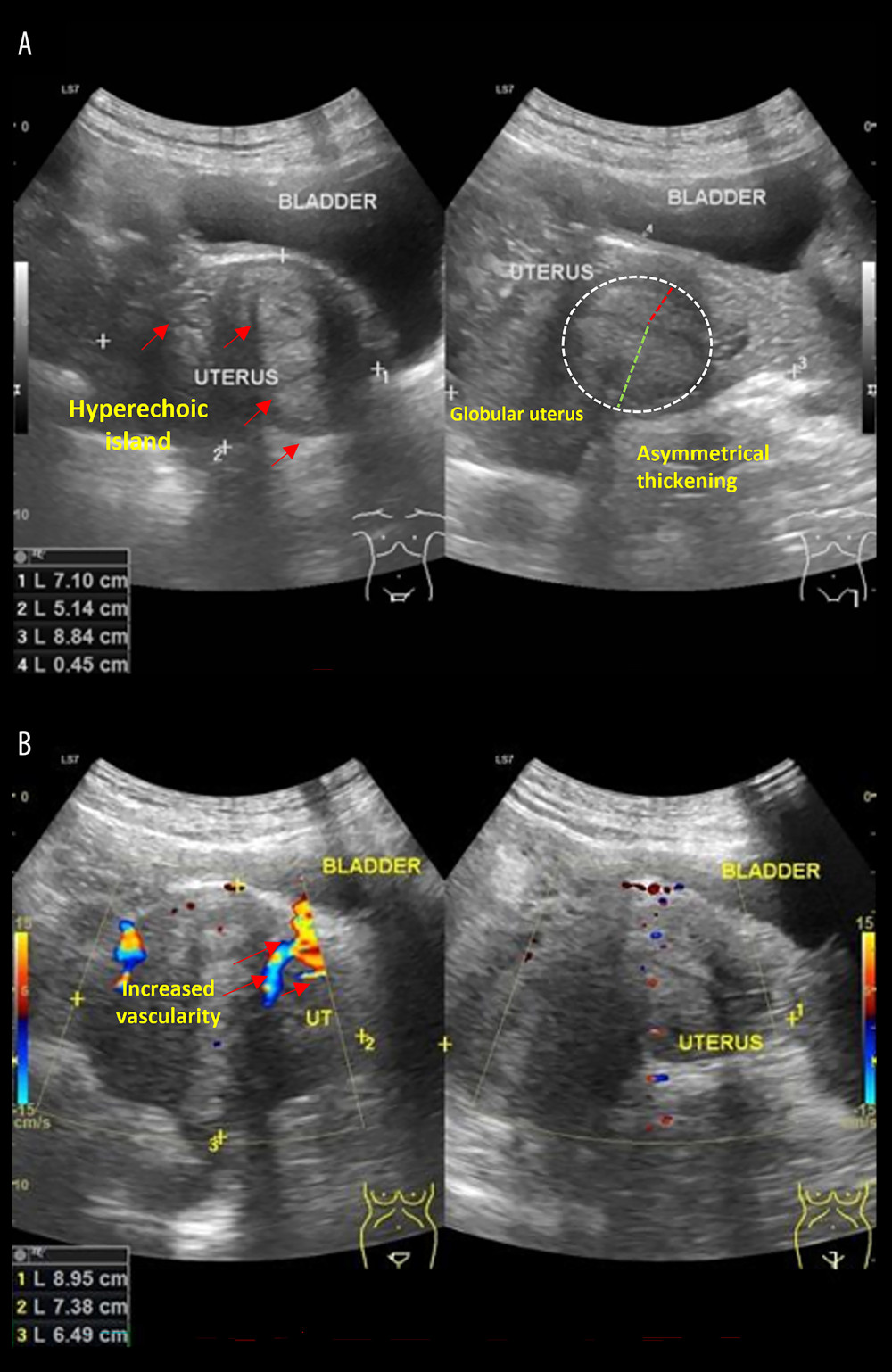 Ultrasonography result in referral hospital. (A) Gray-scale ultrasonography shows hyperechoic islands (red arrows) within the uterine parenchyma, a globular uterine shape, and asymmetrical thickening of the uterine walls (dashed white circle), indicative of possible adenomyosis and endometriosis. (B) Doppler ultrasonography demonstrates increased vascularity (red arrows) within the uterine lesion (perilesion), suggesting endometriosis.