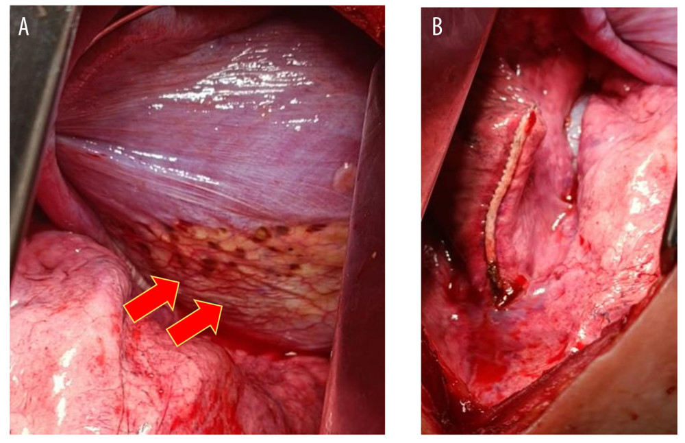 Intraoperative findings. (A) Before endometriosis resection. (B) After endometriosis resection. Red arrow indicates endometriosis implant on the thoracic cavity.