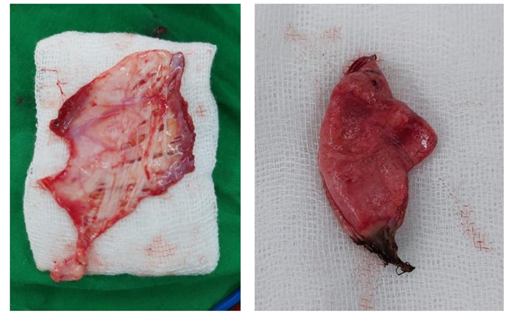 Specimen findings of endometriosis tissue from thoracotomy.