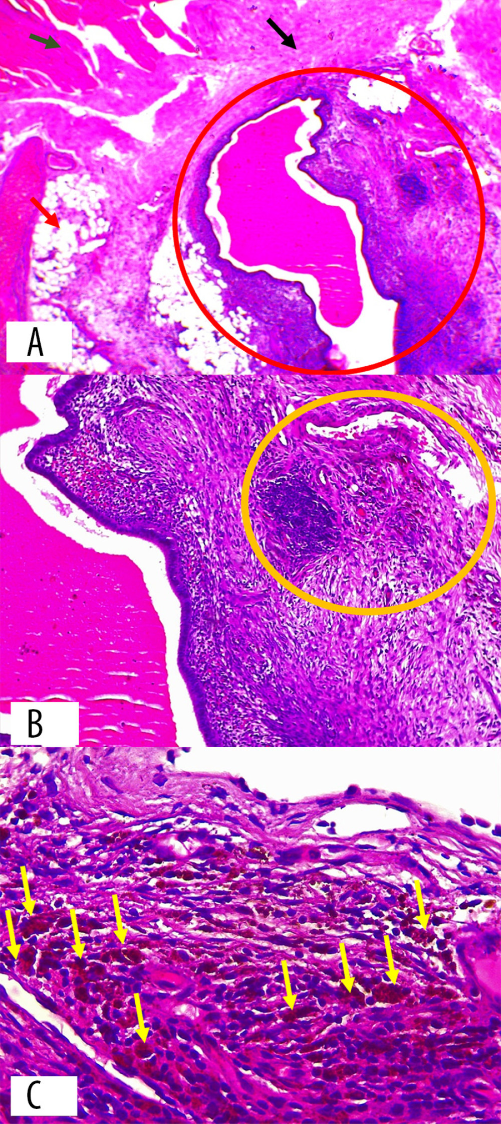 Histopathology result of diaphragm wall. (A) Endometrial glands and stroma (red circle) located between diaphragmatic muscle bundles (green arrow), fibrous connective tissue stroma (black arrow), and adipose tissue (red arrow) (hematoxylin and eosin stain, 40× magnification). (B) Endometrial stroma with hemorrhage and hemosiderin-laden macrophage infiltration (yellow circle) (hematoxylin and eosin stain, 100× magnification). (C) Hemosiderin-laden macrophages with brownish-red stained cytoplasm (yellow arrow) (hematoxylin and eosin stain, 400× magnification).