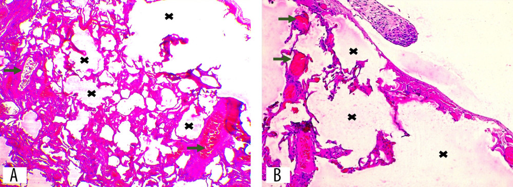 (A, B) Edematous alveolar tissue with vascular proliferation and dilation (green arrow). Severe alveolar distension (black cross) indicates pneumothorax. (A) Hematoxylin and eosin stain, 40× magnification. (B) Hematoxylin and eosin stain, 100× magnification.