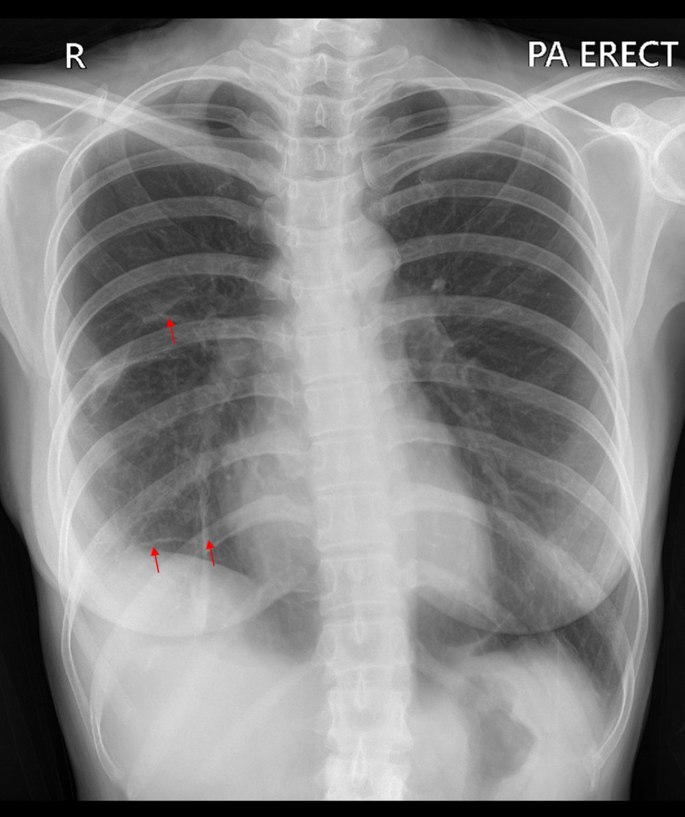 Postoperative chest X-ray shows no signs of progressive pneumothorax. The red arrow indicates visible bronchovascular markings.