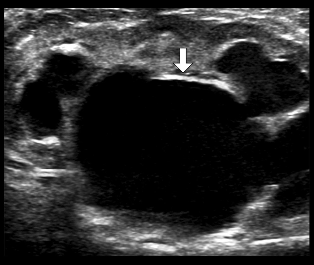 Preoperative renal ultrasound imageGreyscale ultrasound image demonstrating significant hydronephrosis (arrow) with thinning of the renal parenchyma.