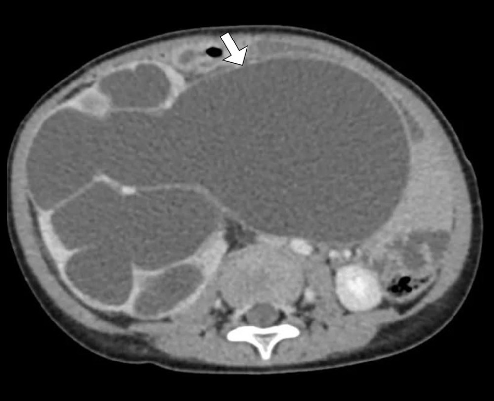 Contrast-enhanced CT scan of the abdomen and pelvis (coronal view)An axial CT image demonstrating massive right-sided hydronephrosis and a dilated renal pelvis. A narrow, atretic segment is observed at the ureteropelvic junction (arrow), consistent with the diagnosis of pyeloureteral atresia.