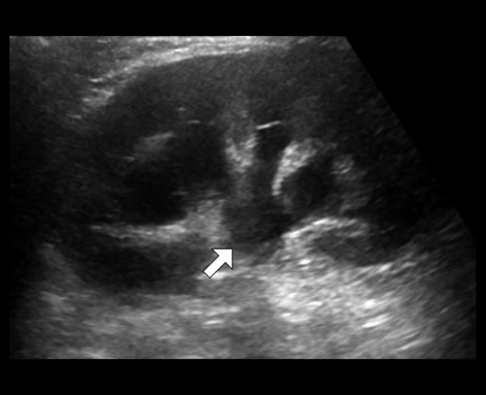 Postoperative renal ultrasound imagePostoperative greyscale ultrasound image demonstrating marked interval improvement in the hydronephrosis (arrow).