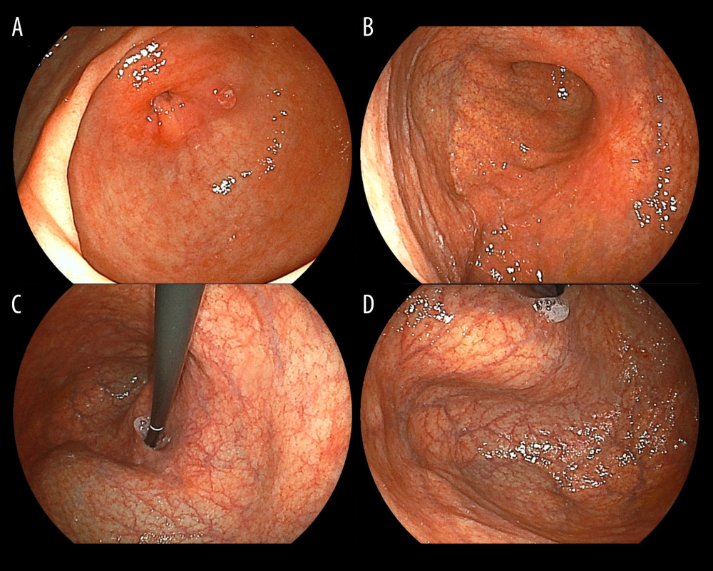 Images obtained using esophagogastroduodenoscopy. (A) Atrophic gastritis is not evident in the pyloric antrum. (B) A gastric ulcer scar was found on the posterior wall of the lower body of the stomach. (C, D) Severe atrophic gastritis was revealed in the upper stomach and the fornix.