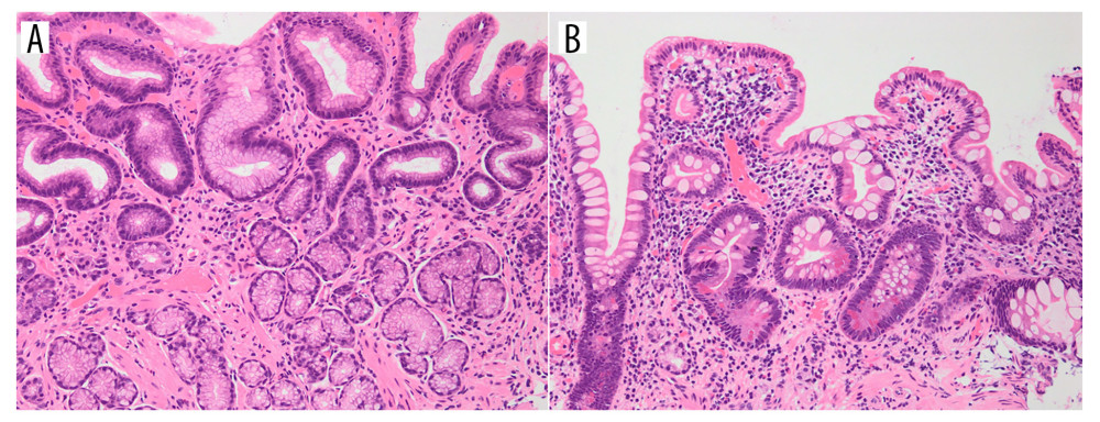 Histopathologic findings of biopsy samples obtained from the stomach. (A) Partial intestinal metaplasia and normal pyloric glands are observed in a biopsy sample obtained from the pyloric region (×400). (B) Hematoxylin and eosin staining of a biopsy sample from the fornix confirmed severe atrophy and loss of gastric fundic glands (×400).