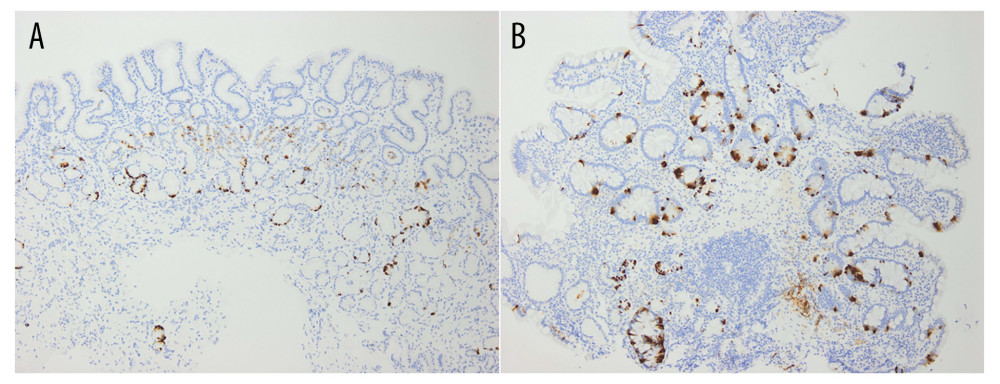 Results of the immunohistochemical staining for detecting chromogranin A. (A) A biopsy sample obtained from the pyloric region reveals an increase in chromogranin A-positive cells (×40). (B) Similarly, chromogranin A-positive cells are observed in the fornix (×40).