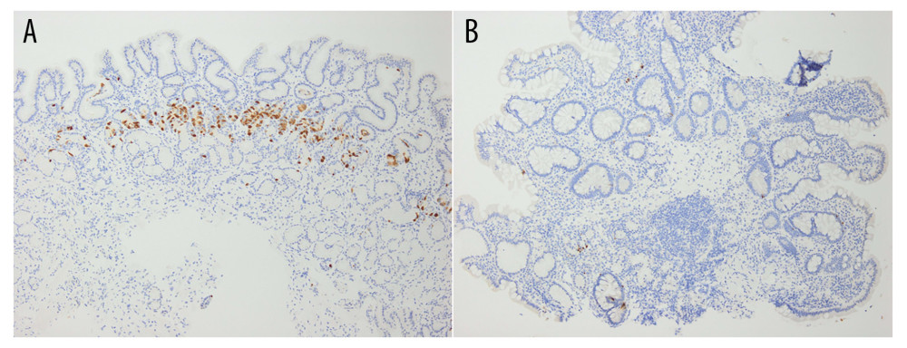 Results of the immunohistochemical staining for detecting gastrin. (A) Hyperplasia of gastrin-positive cells is observed in a biopsy sample obtained from the pyloric region (×40). (B) A loss of gastrin-positive cells is observed in the fornix (×40).