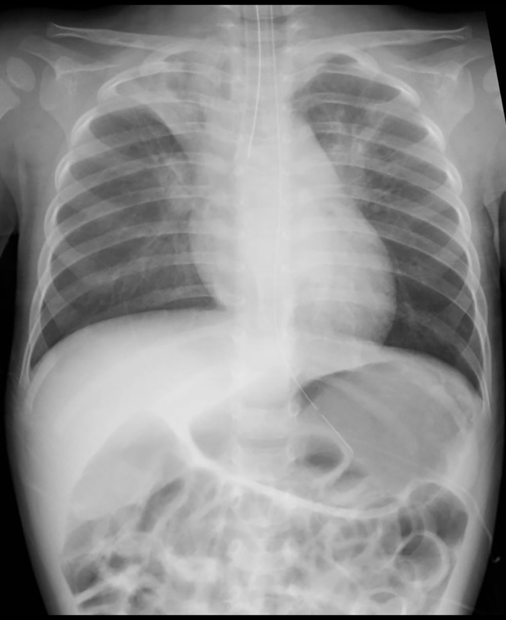 At the time of arrival, a chest radiograph revealed right single-lung intubation.