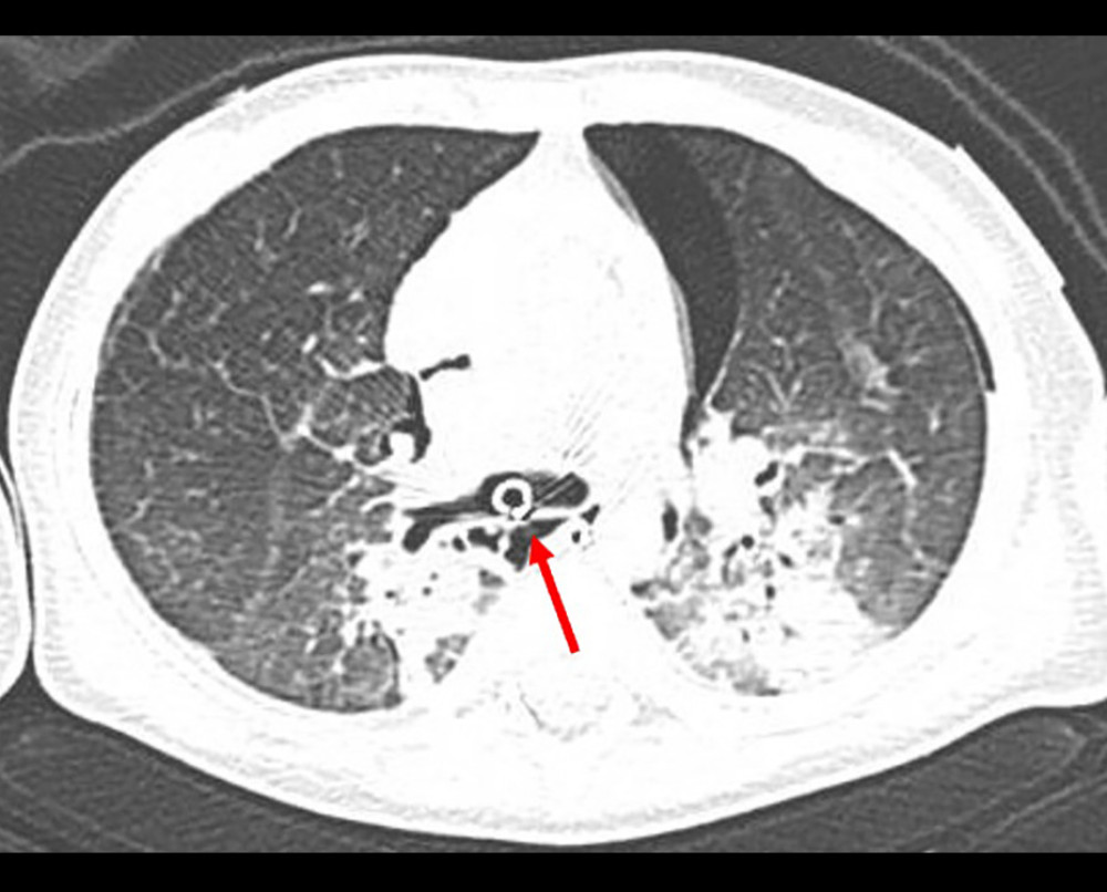 At admission, computed tomography revealed infiltrative shadows indicative of aspiration, left pneumothorax, mediastinal emphysema, and tracheobronchial injury (arrow).