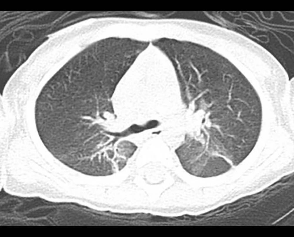 On the sixth day, computed tomography revealed the resolution of the pneumothorax and mediastinal emphysema.