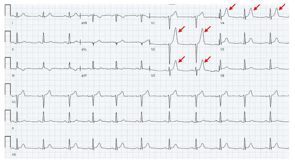 EKG on presentation; red arrows depicting peaked T waves.