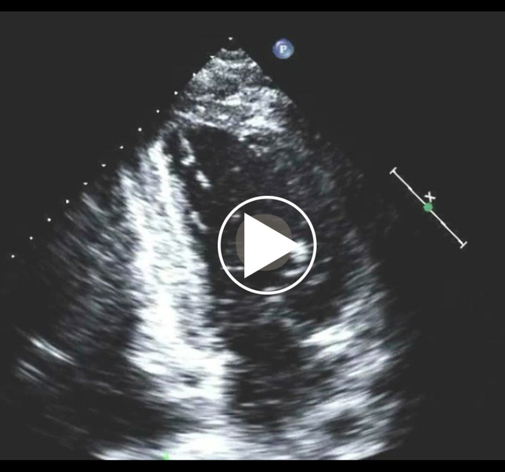 Mid and apical inferoseptal, apical inferior, mid and apical anteroseptal, and apical hypokinesis. The ejection fraction was 50% calculated by biplane method of disks.