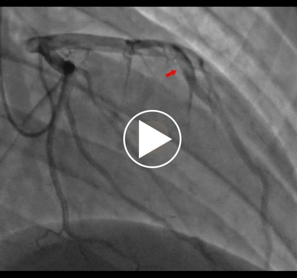 Coronary artery dissection in the mid left anterior descending artery with superimposed thrombus (red arrow) and embolized thrombus to the apical vessel, in a left dominant system (blue arrow).