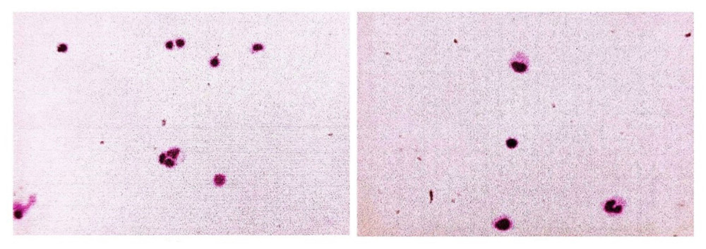 Results of cerebrospinal fluid smear under electron microscopy. Lymphocytes, monocytes, and occasional macrophages are seen under microscopy (cerebrospinal fluid).