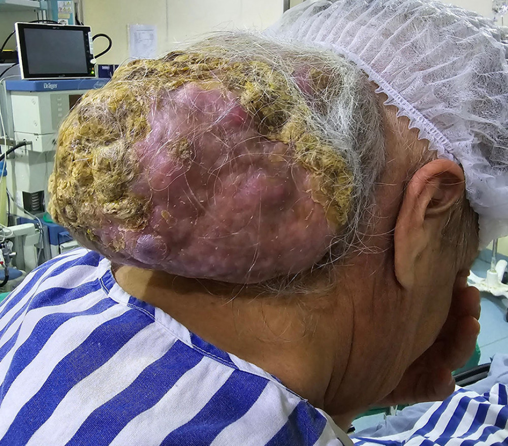 Giant tumor in the occipital region showing areas of hyperkeratosis, erythema, and cystic regions. The mass had been slowly growing for 11 years.