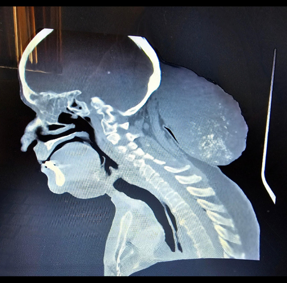 The mass, measuring approximately 15×14×11 cm, was located in the occipital area. Imaging techniques revealed no evidence of bone infiltration or resorption, although areas of calcification were observed within the mass.