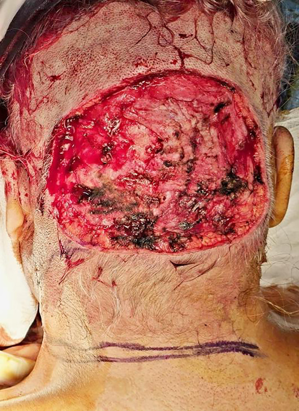 After the mass was surgically excised, a significant defect area was left in the occipital region.