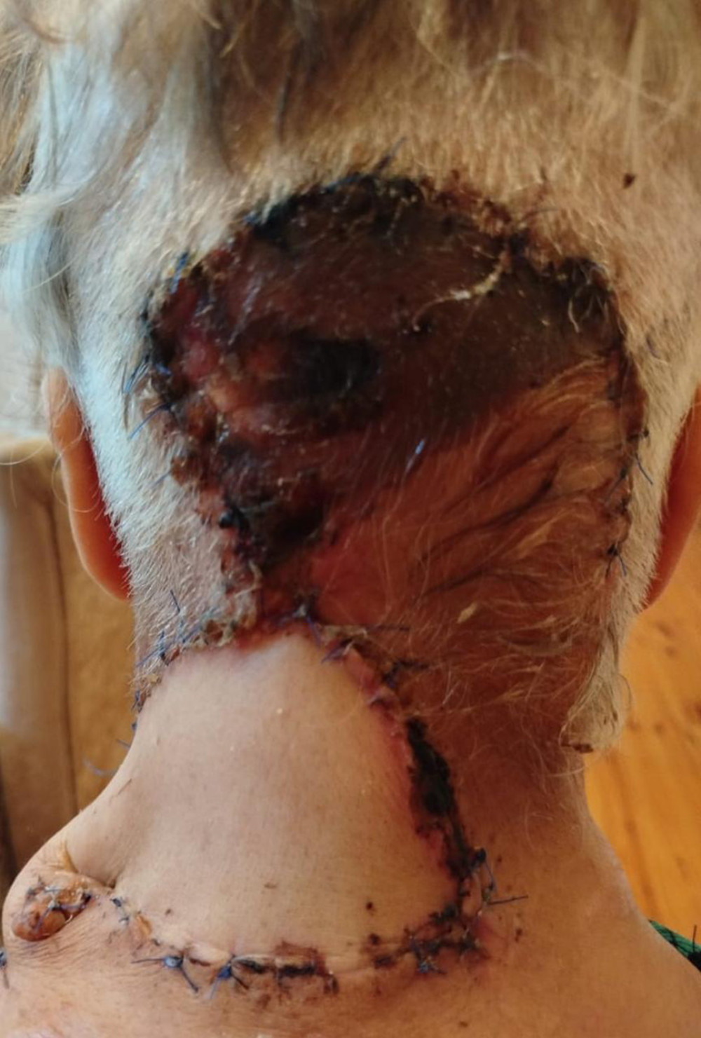 Two weeks postoperatively, necrosis of the damaged tissue and a clear demarcation line were distinctly visible.