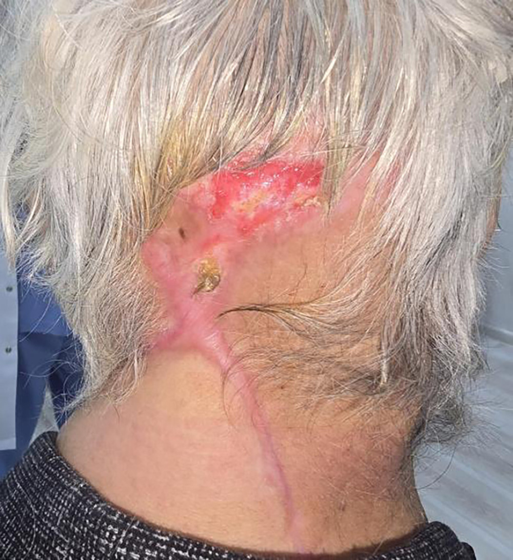 Six months after the surgery, the necrotic tissue was surgically debrided, and the wound was left to heal by secondary intention.