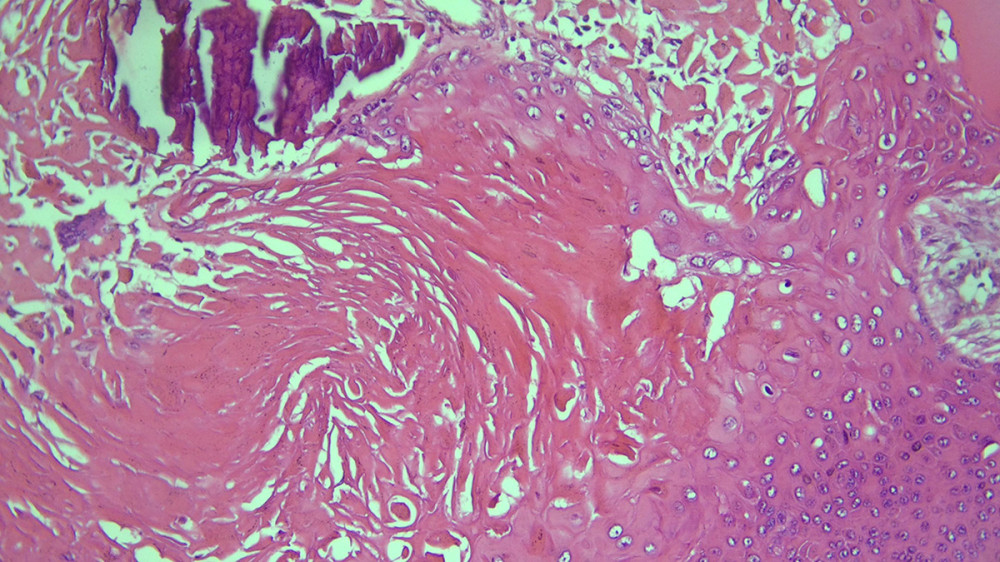 Trichilemmal keratinization, foreign body-type reaction, and calcification (H&E: ×200).