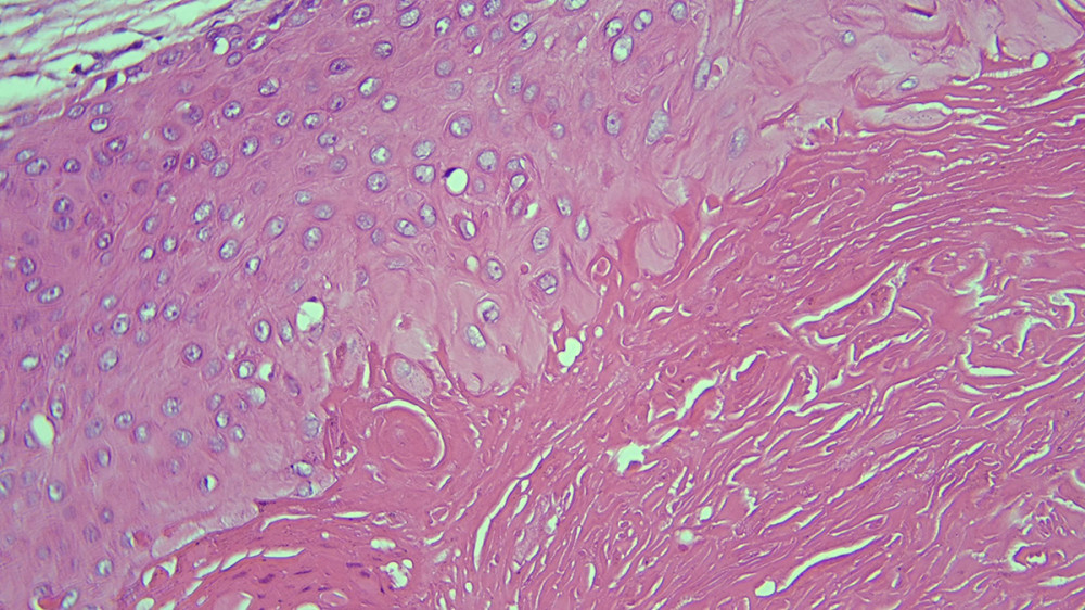Slight atypia, eosinophilic compact keratin showing lamination in squamous epithelium without granular layer (H&E: ×400).