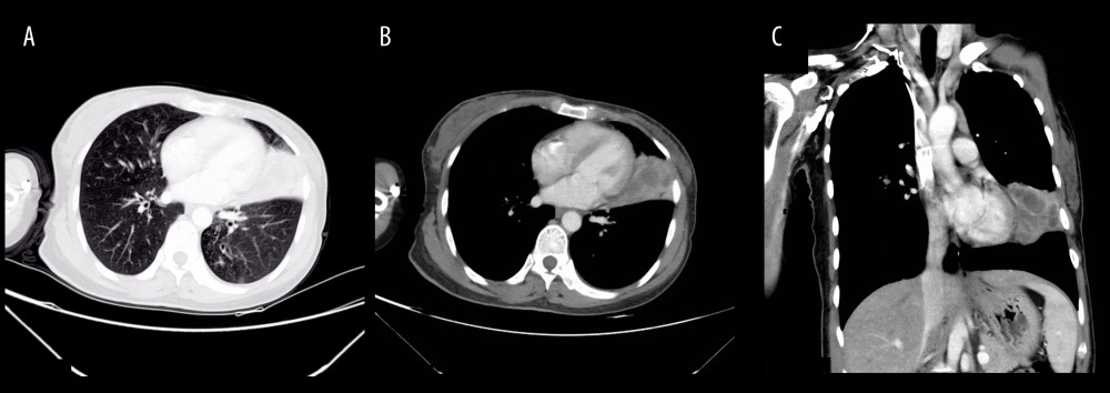 Computed tomography scan showing solid lesions in the lingular segment of the left upper pulmonary lobe. Low-density cystic shadows were observed within the lesions, accompanied by mediastinal lymphadenopathy (A: lung window; B: mediastinal window; C: coronal reconstruction).