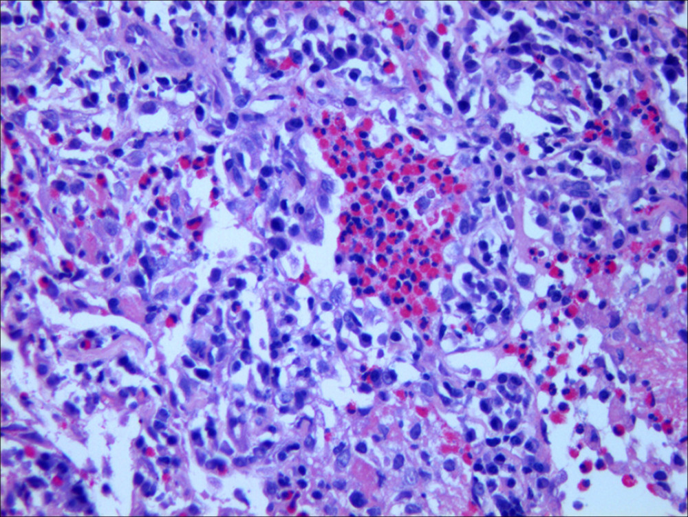Photomicrograph showing eosinophilic infiltration in the alveoli and interstitium, consistent with eosinophilic pneumonia. Images obtained after hematoxylin and eosin staining at 200× magnification.