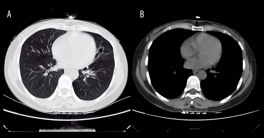 Computed tomography scan demonstrating resolution of lesions in the lingular segment of the left upper lobe (A: lung window; B: mediastinal window).