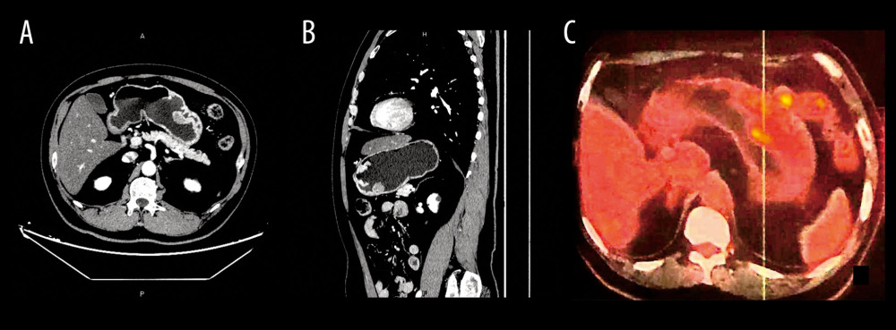 (A, B) Enhanced abdominal computed tomography (CT) scan image of primary gastric follicular lymphoma; (C) Positron emission tomography-computed tomography (PET-CT) image of primary gastric follicular lymphoma.
