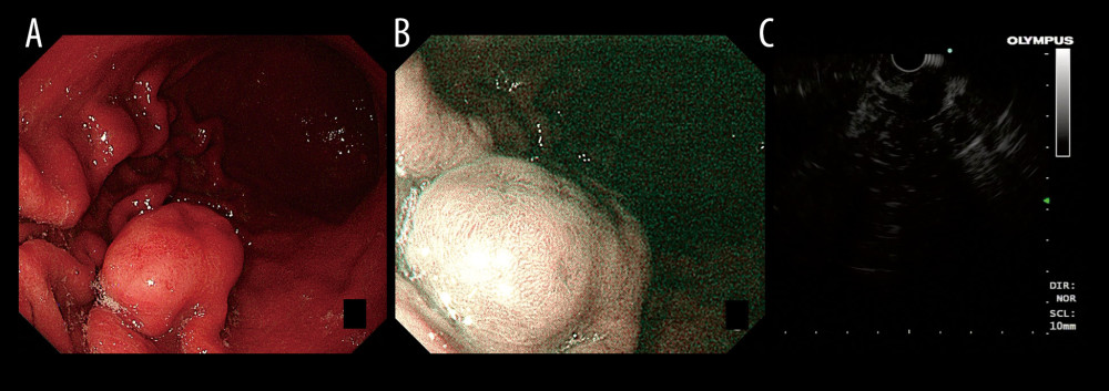 Endoscopy images of primary gastric follicular lymphoma: (A) White-light; (B) Narrow-band; (C) Endoscopic ultrasound.