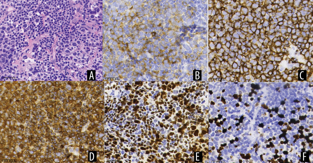 Immunohistochemistry: (A) Hematoxylin and eosin (H&E) staining, ×60; (B) CD10 expression, ×60; (C) CD20 expression, ×60; (D) BCL-2 expression, ×60; (E) BCL-6 expression, ×60; (F) Ki-67 expression, ×60.
